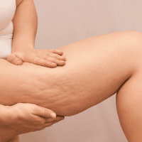 Cellulite Treatment