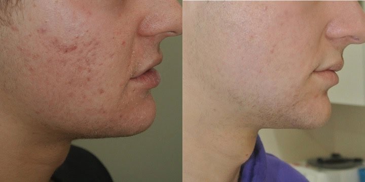 Acne Treatment Calgary