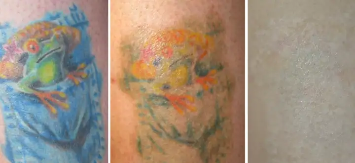 Tattoo Removal Calgary