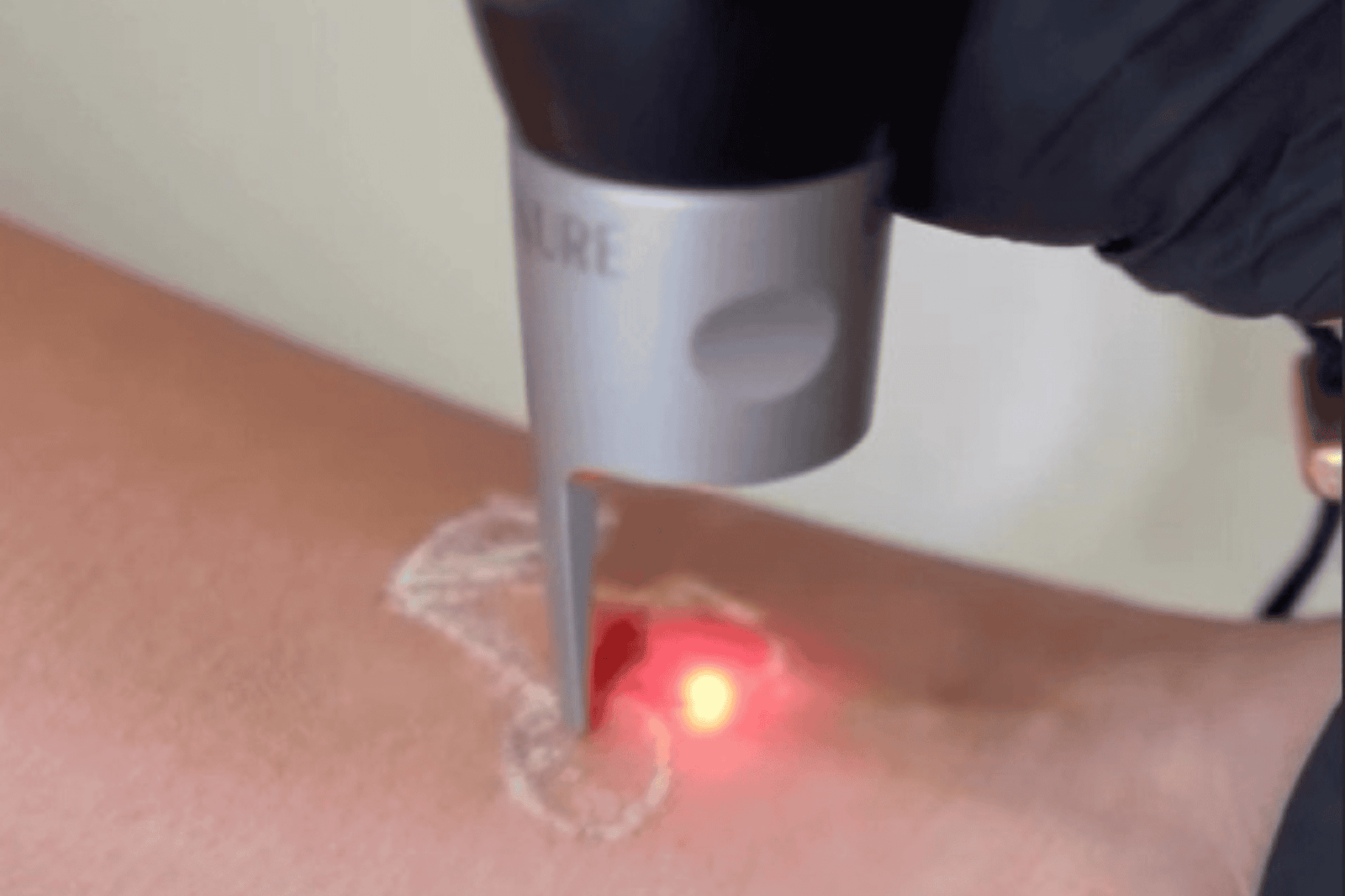 CaVaBien Spa & Salon | Does Pico Laser Tattoo Really Work? Calgary’s Expert Guide 